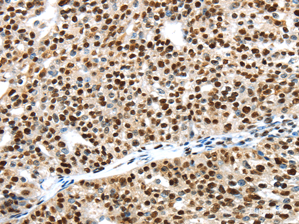 Immunohistochemistry of paraffin-embedded Human breast cancer using UBA1 Polyclonal Antibody at dilution of  1/40