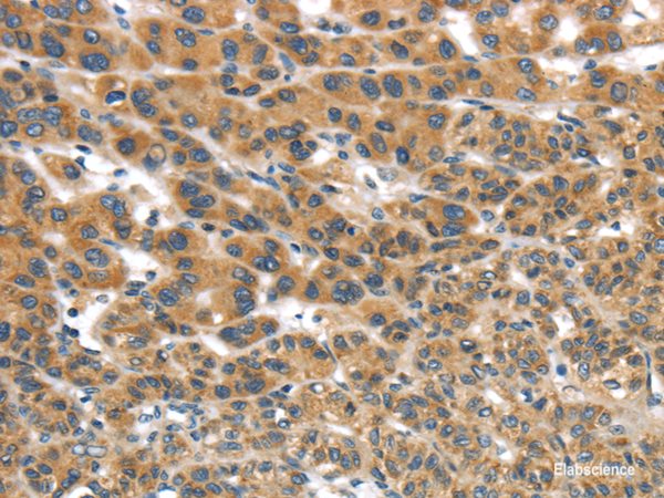 Immunohistochemistry of paraffin-embedded Human liver cancer tissue using UBTD2 Polyclonal Antibody at dilution 1:35