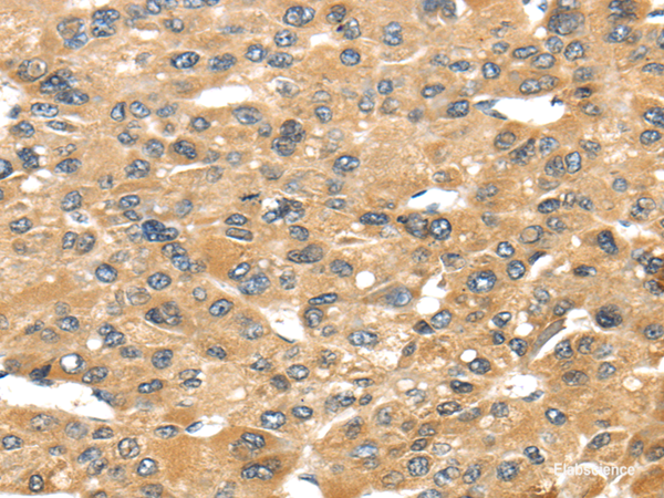 Immunohistochemistry of paraffin-embedded Human liver cancer tissue using UCP1 Polyclonal Antibody at dilution 1:40