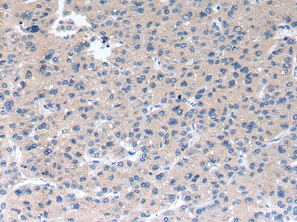 Immunohistochemistry of paraffin-embedded Human liver cancer using RAB2A Polyclonal Antibody at dilution of  1/40