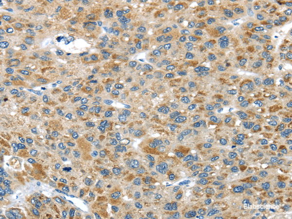 Immunohistochemistry of paraffin-embedded Human liver cancer tissue using USP9X Polyclonal Antibody at dilution 1:40
