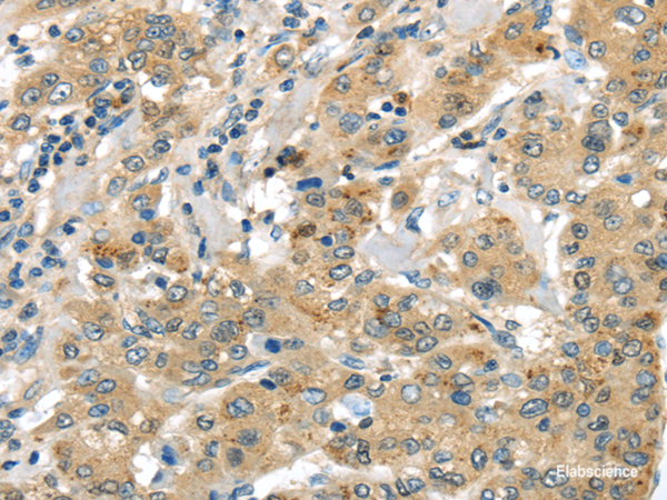 Immunohistochemistry of paraffin-embedded Human liver cancer using UTS2B Polyclonal Antibody at dilution of  1/35