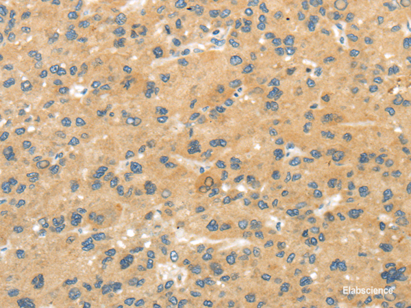 Immunohistochemistry of paraffin-embedded Human liver cancer tissue using MPP6 Polyclonal Antibody at dilution 1:40