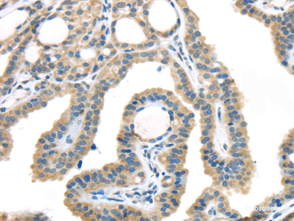 Immunohistochemistry of paraffin-embedded Human thyroid cancer using VGF Polyclonal Antibody at dilution of  1/45