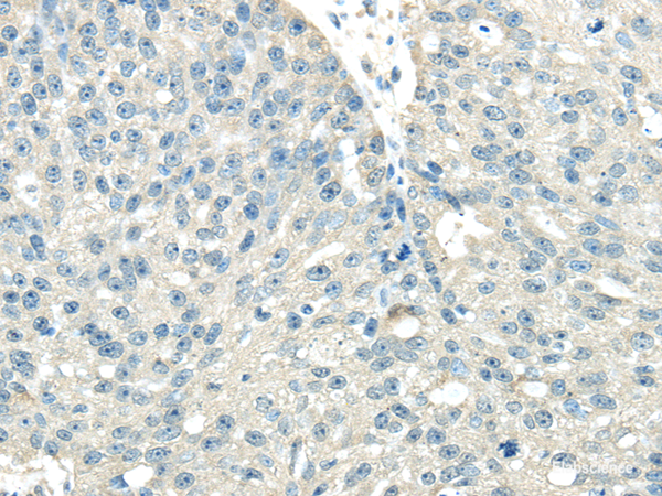 Immunohistochemistry of paraffin-embedded Human breast cancer tissue using VPS36 Polyclonal Antibody at dilution 1:40