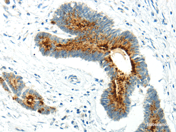 Immunohistochemistry of paraffin-embedded Human colorectal cancer using WWOX Polyclonal Antibody at dilution of  1/20