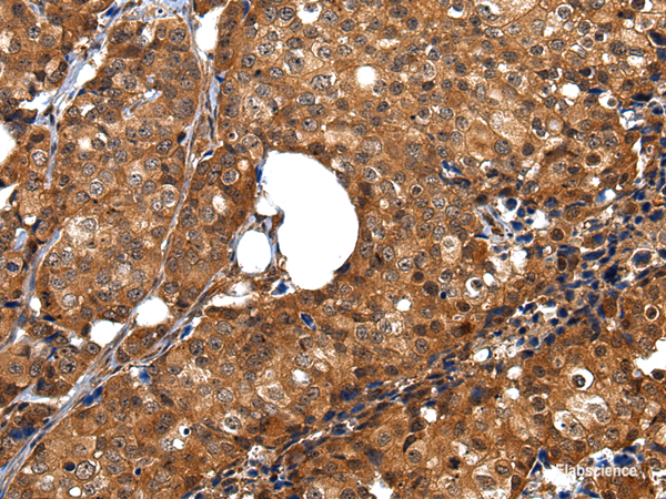 Immunohistochemistry of paraffin-embedded Human breast cancer tissue using ZBTB2 Polyclonal Antibody at dilution 1:40