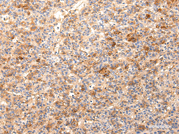 Immunohistochemistry of paraffin-embedded Human liver cancer using ZNF365 Polyclonal Antibody at dilution of  1/20