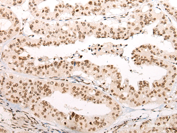 Immunohistochemistry of paraffin-embedded Human liver cancer tissue  using VPS51 Polyclonal Antibody at dilution of 1:65(×200)