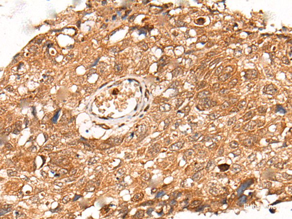 Immunohistochemistry of paraffin-embedded Human lung cancer tissue  using KLHL36 Polyclonal Antibody at dilution of 1:55(×200)