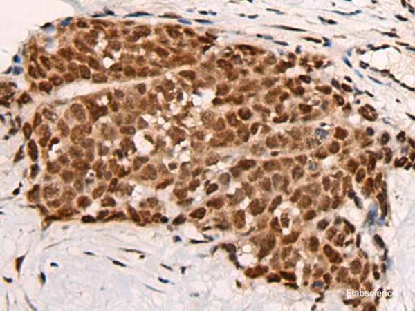 Immunohistochemistry of paraffin-embedded Human thyroid cancer tissue  using HGH1 Polyclonal Antibody at dilution of 1:45(×200)