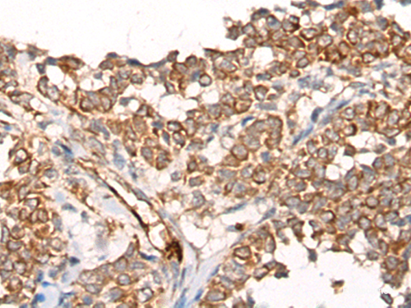 Immunohistochemistry of paraffin-embedded Human ovarian cancer tissue  using CA5B Polyclonal Antibody at dilution of 1:65(×200)