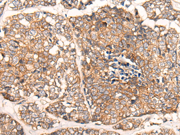 Immunohistochemistry of paraffin-embedded Human esophagus cancer tissue  using CACNA2D2 Polyclonal Antibody at dilution of 1:45(×200)