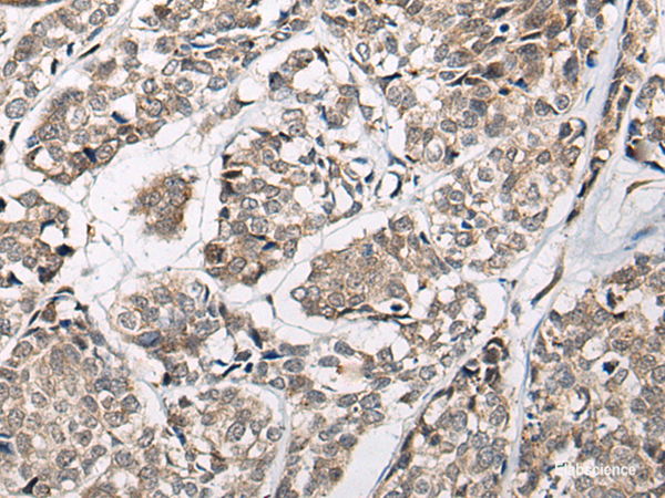 Immunohistochemistry of paraffin-embedded Human esophagus cancer tissue  using CACNB3 Polyclonal Antibody at dilution of 1:55(×200)
