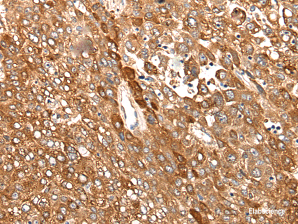 Immunohistochemistry of paraffin-embedded Human liver cancer tissue  using CAD Polyclonal Antibody at dilution of 1:50(×200)
