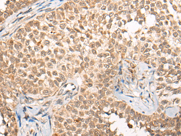 Immunohistochemistry of paraffin-embedded Human ovarian cancer tissue  using CABIN1 Polyclonal Antibody at dilution of 1:50(×200)