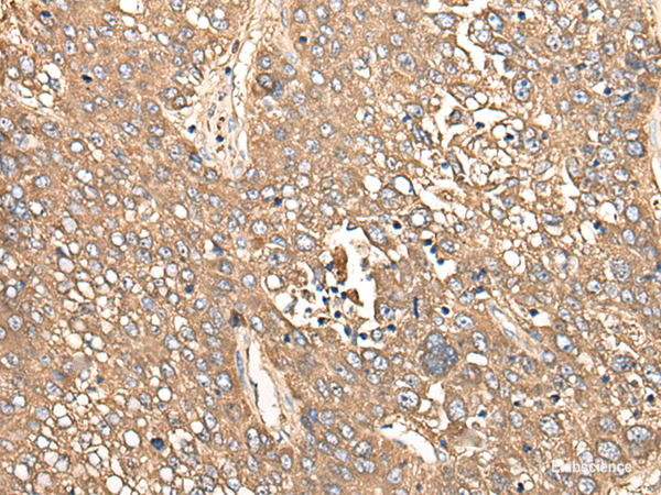 Immunohistochemistry of paraffin-embedded Human liver cancer tissue  using CALB1 Polyclonal Antibody at dilution of 1:80(×200)