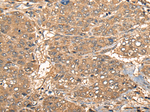 Immunohistochemistry of paraffin-embedded Human liver cancer tissue  using CCL27 Polyclonal Antibody at dilution of 1:55(×200)