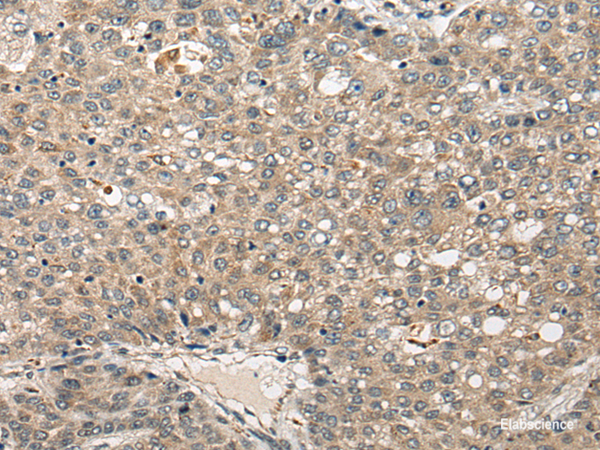 Immunohistochemistry of paraffin-embedded Human liver cancer tissue  using FUT4 Polyclonal Antibody at dilution of 1:40(×200)