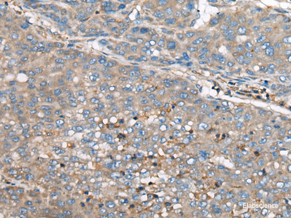 Immunohistochemistry of paraffin-embedded Human liver cancer tissue  using GULP1 Polyclonal Antibody at dilution of 1:65(×200)