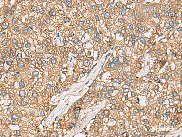 Immunohistochemistry of paraffin-embedded Human liver cancer tissue  using CHKA Polyclonal Antibody at dilution of 1:35(×200)