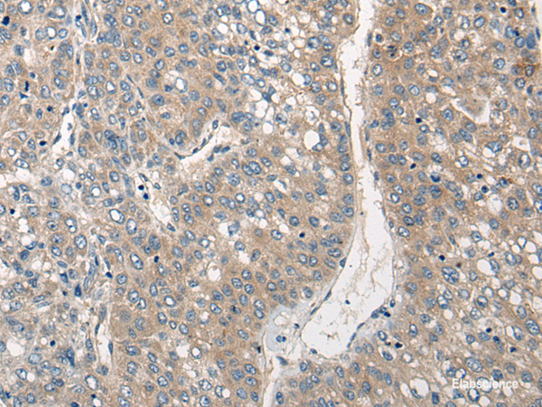 Immunohistochemistry of paraffin-embedded Human liver cancer tissue  using CLIC6 Polyclonal Antibody at dilution of 1:40(×200)