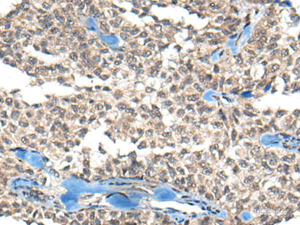 Immunohistochemistry of paraffin-embedded Human ovarian cancer tissue  using REST Polyclonal Antibody at dilution of 1:50(×200)