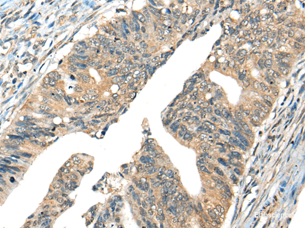 Immunohistochemistry of paraffin-embedded Human colorectal cancer tissue  using AIFM2 Polyclonal Antibody at dilution of 1:40(×200)