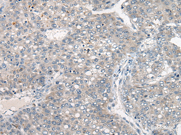 Immunohistochemistry of paraffin-embedded Human liver cancer tissue  using DGKI Polyclonal Antibody at dilution of 1:80(×200)
