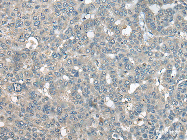 Immunohistochemistry of paraffin-embedded Human liver cancer tissue  using UCN3 Polyclonal Antibody at dilution of 1:55(×200)