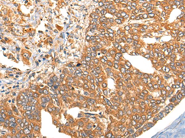 Immunohistochemistry of paraffin-embedded Human liver cancer tissue  using UBIAD1 Polyclonal Antibody at dilution of 1:40(×200)