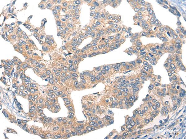 Immunohistochemistry of paraffin-embedded Human liver cancer tissue  using GPR55 Polyclonal Antibody at dilution of 1:55(×200)