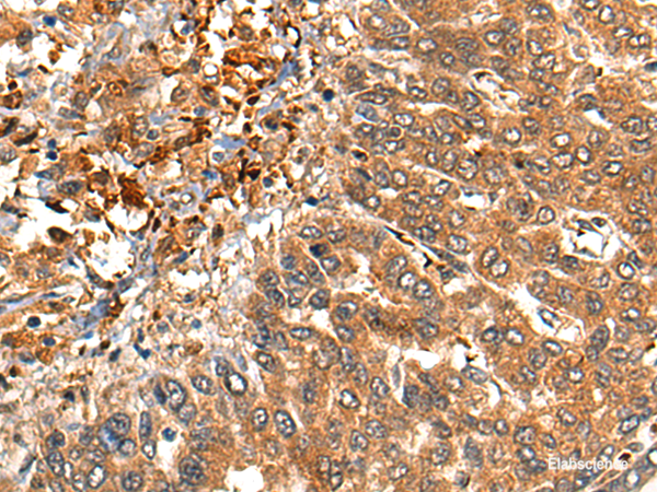 Immunohistochemistry of paraffin-embedded Human liver cancer tissue  using MARK3 Polyclonal Antibody at dilution of 1:40(×200)
