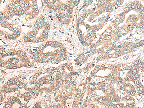 Immunohistochemistry of paraffin-embedded Human liver cancer tissue  using PCDHGB5 Polyclonal Antibody at dilution of 1:40(×200)