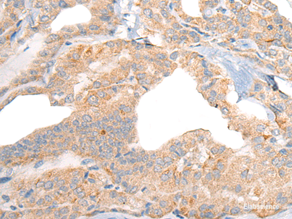 Immunohistochemistry of paraffin-embedded Human thyroid cancer tissue  using RGS19 Polyclonal Antibody at dilution of 1:40(×200)