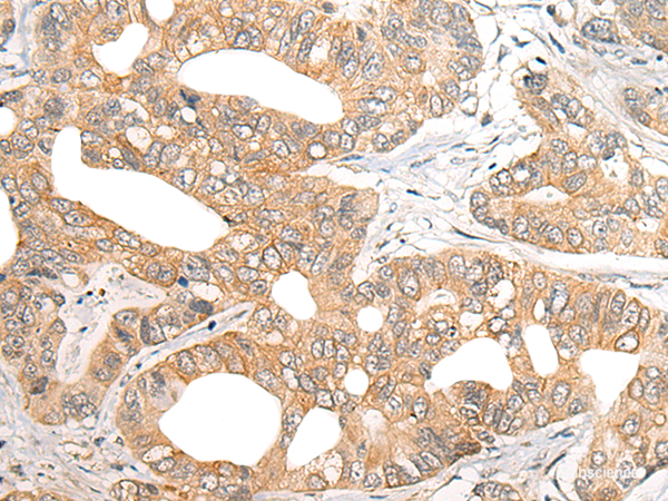 Immunohistochemistry of paraffin-embedded Human gastric cancer tissue  using SNX6 Polyclonal Antibody at dilution of 1:40(×200)