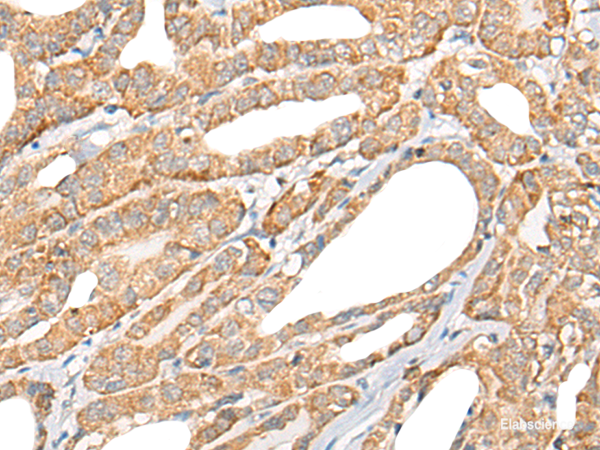 Immunohistochemistry of paraffin-embedded Human thyroid cancer tissue  using CCL5 Polyclonal Antibody at dilution of 1:50(×200)