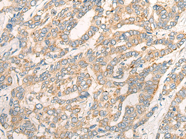 Immunohistochemistry of paraffin-embedded Human liver cancer tissue  using CCL16 Polyclonal Antibody at dilution of 1:45(×200)