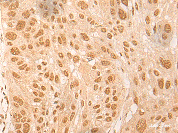 Immunohistochemistry of paraffin-embedded Human esophagus cancer tissue  using DBP Polyclonal Antibody at dilution of 1:25(×200)