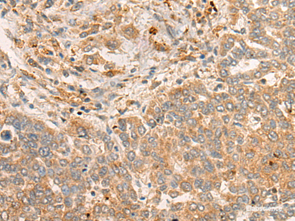 Immunohistochemistry of paraffin-embedded Human liver cancer tissue  using FBXO32 Polyclonal Antibody at dilution of 1:45(×200)