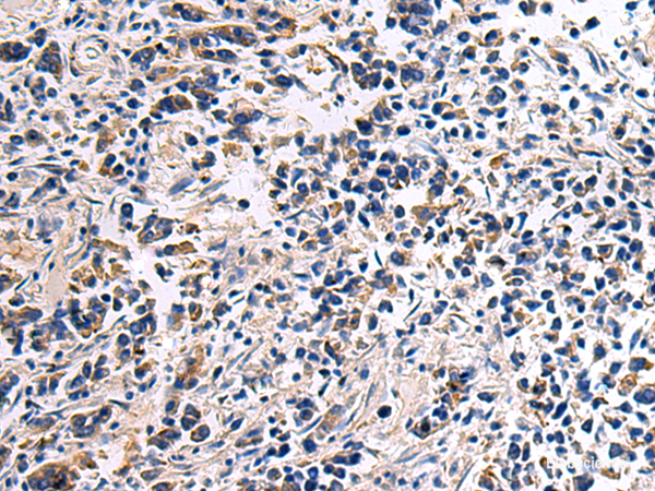 Immunohistochemistry of paraffin-embedded Human breast cancer tissue  using DRGX Polyclonal Antibody at dilution of 1:45(×200)