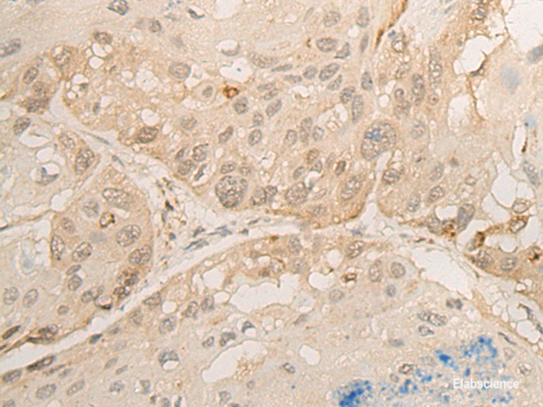 Immunohistochemistry of paraffin-embedded Human esophagus cancer tissue  using DROSHA Polyclonal Antibody at dilution of 1:45(×200)