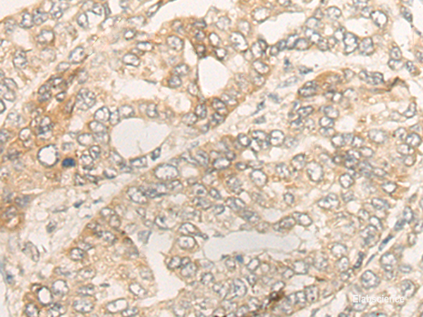 Immunohistochemistry of paraffin-embedded Human liver cancer tissue  using DUOX2 Polyclonal Antibody at dilution of 1:40(×200)