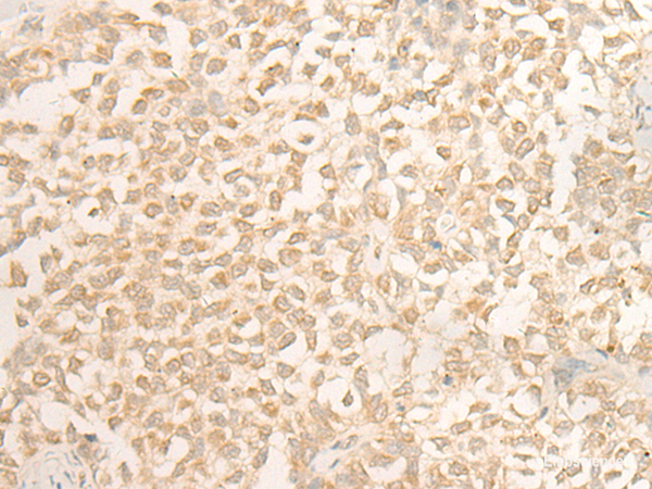 Immunohistochemistry of paraffin-embedded Human ovarian cancer tissue  using DUSP27 Polyclonal Antibody at dilution of 1:50(×200)
