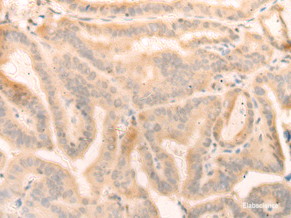 Immunohistochemistry of paraffin-embedded Human thyroid cancer tissue  using ELP4 Polyclonal Antibody at dilution of 1:25(×200)