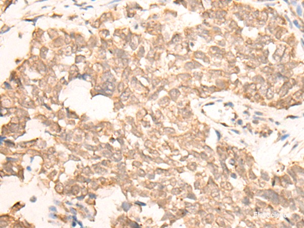 Immunohistochemistry of paraffin-embedded Human lung cancer tissue  using EMSY Polyclonal Antibody at dilution of 1:25(×200)