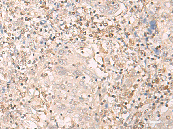 Immunohistochemistry of paraffin-embedded Human cervical cancer tissue  using EPSTI1 Polyclonal Antibody at dilution of 1:25(×200)