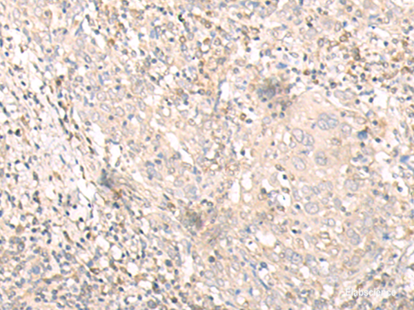 Immunohistochemistry of paraffin-embedded Human cervical cancer tissue  using IL24 Polyclonal Antibody at dilution of 1:30(×200)