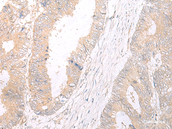 Immunohistochemistry of paraffin-embedded Human colorectal cancer tissue  using HLA-C Polyclonal Antibody at dilution of 1:25(×200)