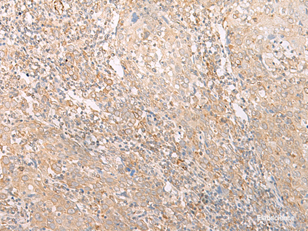 Immunohistochemistry of paraffin-embedded Human cervical cancer tissue  using EPS15 Polyclonal Antibody at dilution of 1:50(×200)